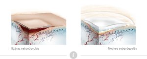 moist-wound-healing_in-general
